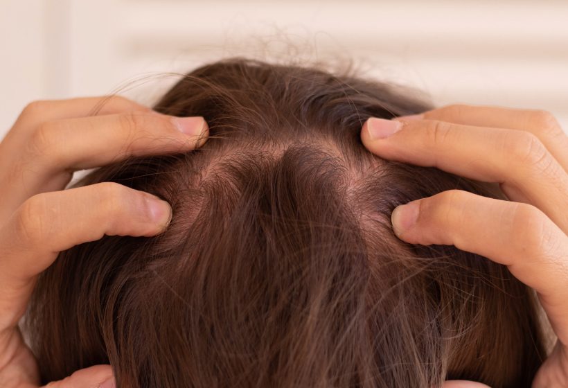 頭皮紅腫癢：原來頭皮毛囊炎也會導致掉髮?